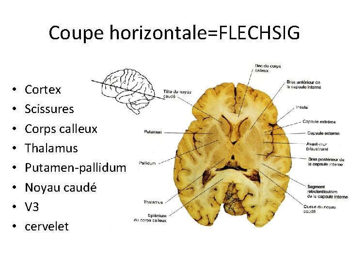 Coupe horizontale=FLECHSIG • • Cortex Scissures Corps calleux Thalamus Putamen-pallidum Noyau caudé V 3