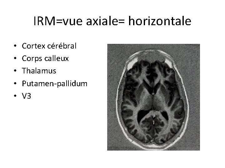 IRM=vue axiale= horizontale • • • Cortex cérébral Corps calleux Thalamus Putamen-pallidum V 3