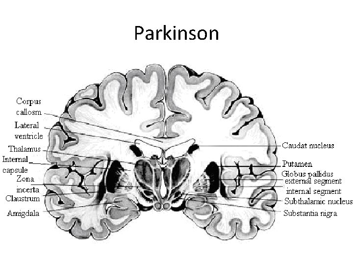 Parkinson 
