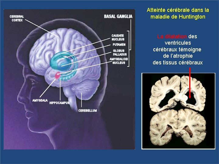 Atteinte cérébrale dans la maladie de Huntington La dilatation des ventricules cérébraux témoigne de