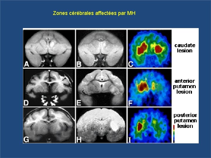 Zones cérébrales affectées par MH 