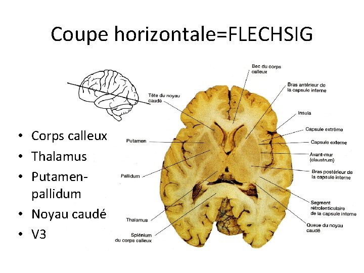 Coupe horizontale=FLECHSIG • Corps calleux • Thalamus • Putamenpallidum • Noyau caudé • V