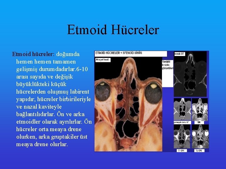 Etmoid Hücreler Etmoid hücreler: doğumda hemen tamamen gelişmiş durumdadırlar. 6 -10 arası sayıda ve