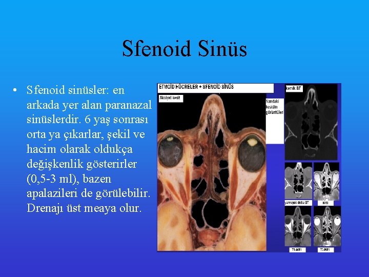 Sfenoid Sinüs • Sfenoid sinüsler: en arkada yer alan paranazal sinüslerdir. 6 yaş sonrası