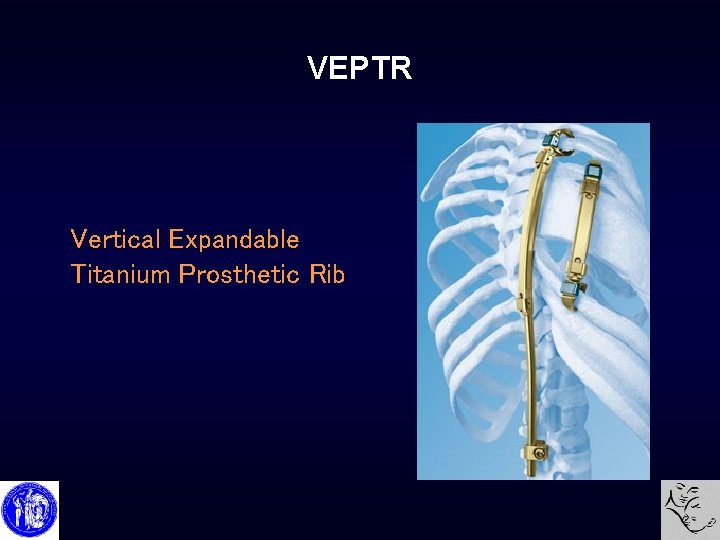 VEPTR Vertical Expandable Titanium Prosthetic Rib 