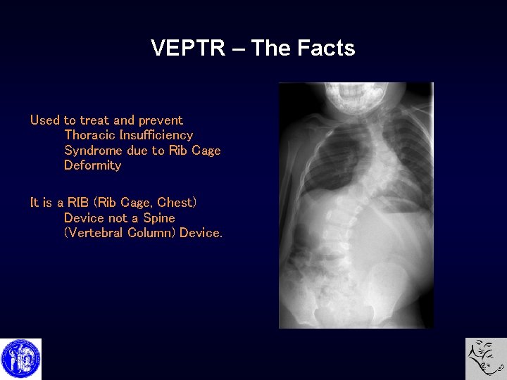 VEPTR – The Facts Used to treat and prevent Thoracic Insufficiency Syndrome due to