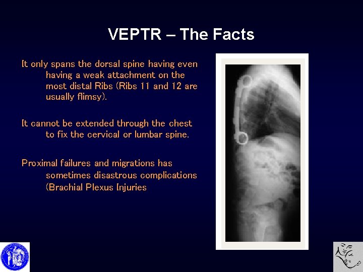 VEPTR – The Facts It only spans the dorsal spine having even having a