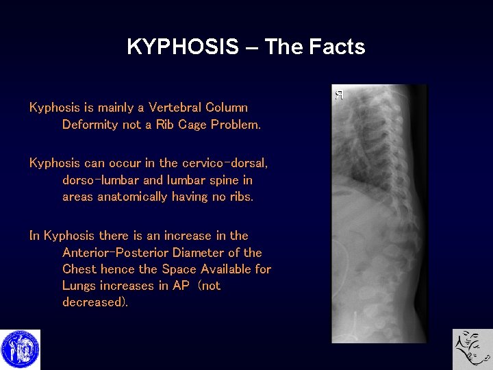 KYPHOSIS – The Facts Kyphosis is mainly a Vertebral Column Deformity not a Rib