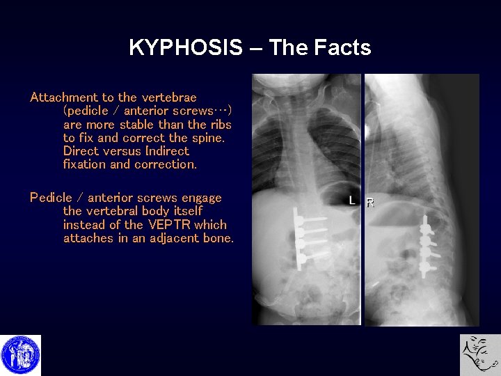 KYPHOSIS – The Facts Attachment to the vertebrae (pedicle / anterior screws…) are more