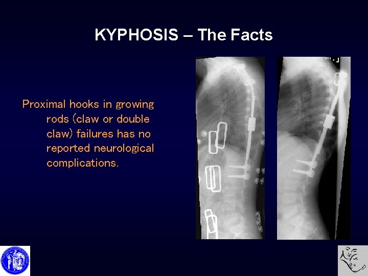 KYPHOSIS – The Facts Proximal hooks in growing rods (claw or double claw) failures