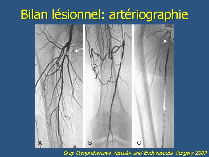 Bilan lésionnel: artériographie Gray Comprehensive Vascular and Endovascular Surgery 2009 