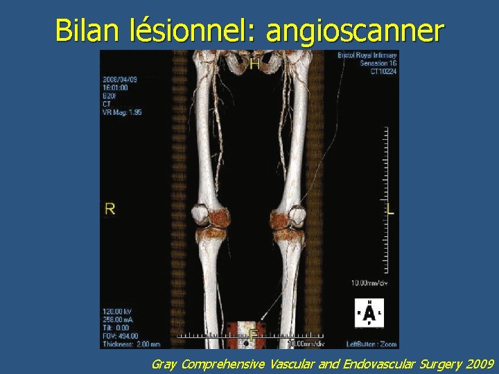 Bilan lésionnel: angioscanner Gray Comprehensive Vascular and Endovascular Surgery 2009 