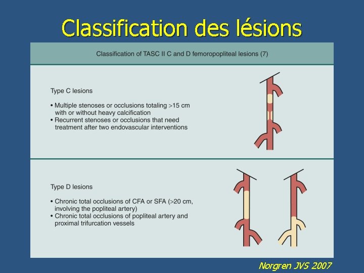Classification des lésions Norgren JVS 2007 
