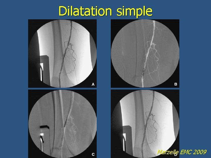 Dilatation simple Marzelle EMC 2009 