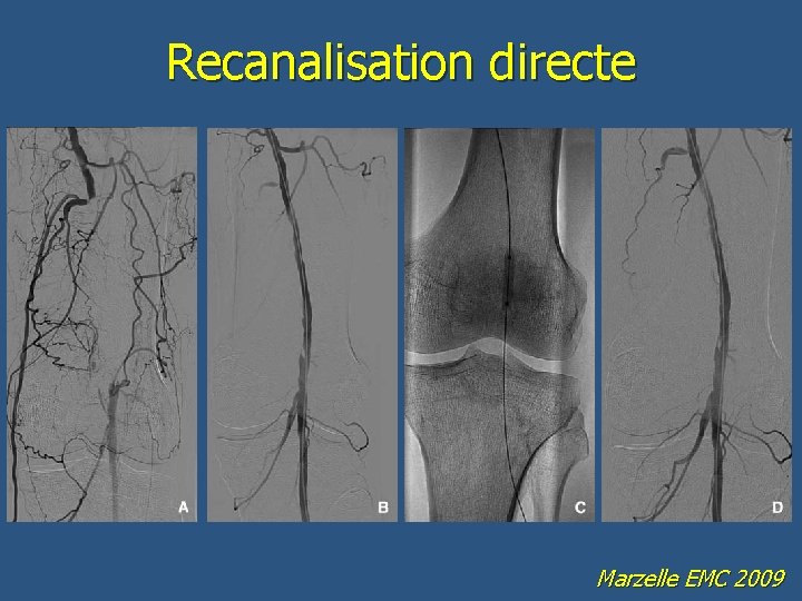 Recanalisation directe Marzelle EMC 2009 