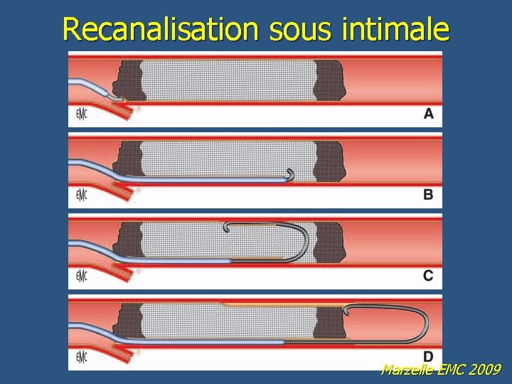 Recanalisation sous intimale Marzelle EMC 2009 