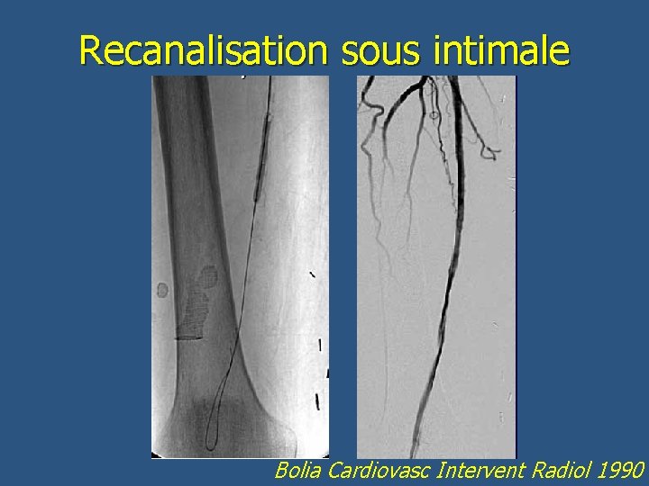 Recanalisation sous intimale Bolia Cardiovasc Intervent Radiol 1990 