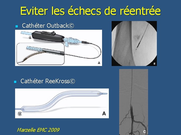 Eviter les échecs de réentrée n n Cathéter Outback© Cathéter Ree. Kross© Marzelle EMC
