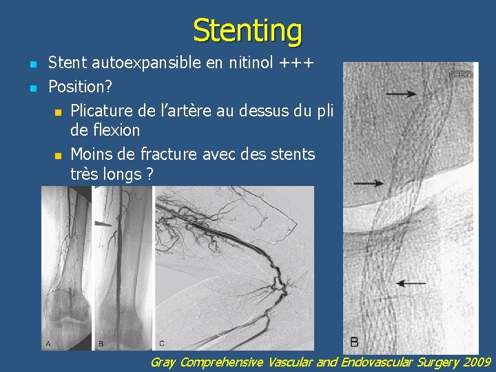 Stenting n n Stent autoexpansible en nitinol +++ Position? n Plicature de l’artère au