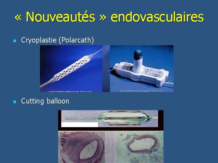  « Nouveautés » endovasculaires n Cryoplastie (Polarcath) n Cutting balloon 