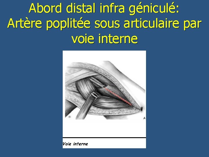 Abord distal infra géniculé: Artère poplitée sous articulaire par voie interne 