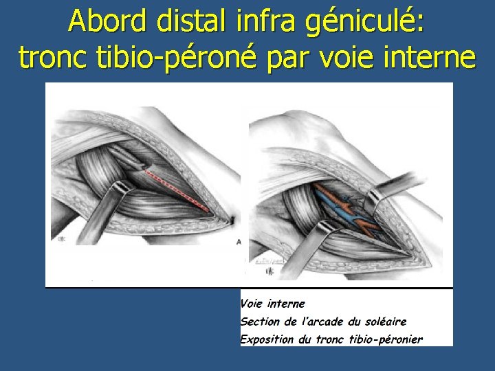 Abord distal infra géniculé: tronc tibio-péroné par voie interne 