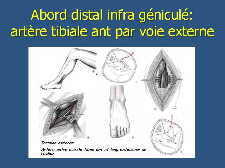 Abord distal infra géniculé: artère tibiale ant par voie externe 