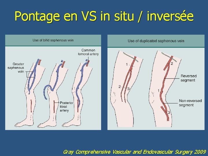 Pontage en VS in situ / inversée Gray Comprehensive Vascular and Endovascular Surgery 2009