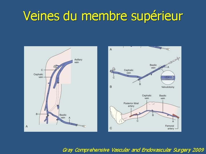 Veines du membre supérieur Gray Comprehensive Vascular and Endovascular Surgery 2009 