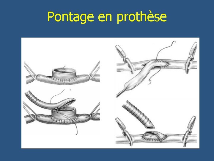 Pontage en prothèse 