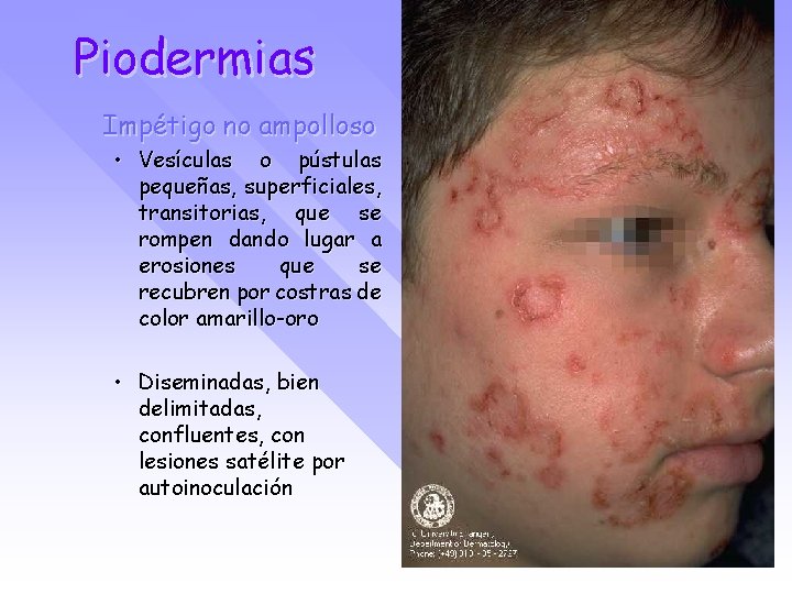 Piodermias Impétigo no ampolloso • Vesículas o pústulas pequeñas, superficiales, transitorias, que se rompen