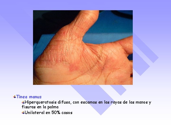 Tinea manus Hiperqueratosis difusa, con escamas en las rayas de las manos y fisuras