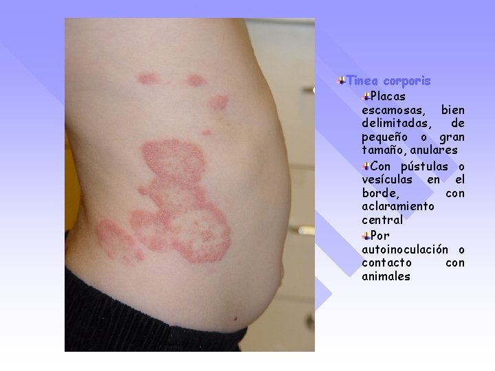 Tinea corporis Placas escamosas, bien delimitadas, de pequeño o gran tamaño, anulares Con pústulas