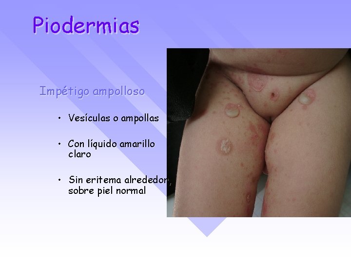 Piodermias Impétigo ampolloso • Vesículas o ampollas • Con líquido amarillo claro • Sin