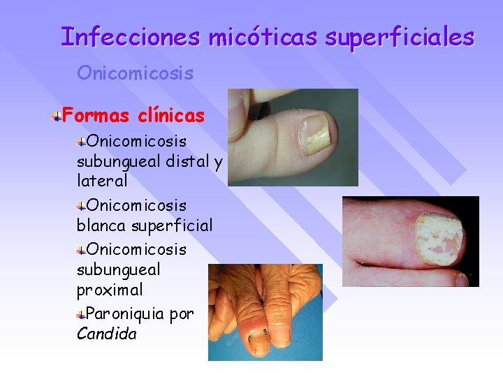 Infecciones micóticas superficiales Onicomicosis Formas clínicas Onicomicosis subungueal distal y lateral Onicomicosis blanca superficial