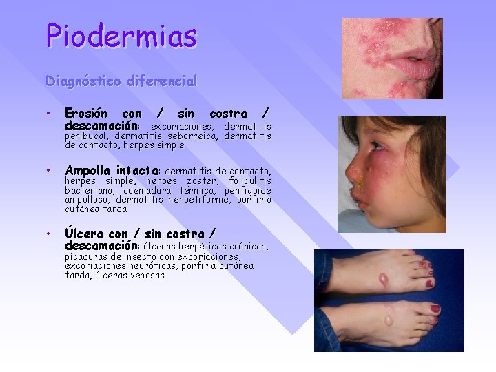 Piodermias Diagnóstico diferencial • Erosión con descamación: / sin costra / • Ampolla intacta: