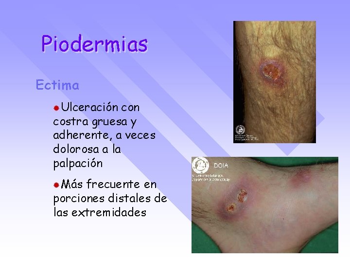 Piodermias Ectima ®Ulceración costra gruesa y adherente, a veces dolorosa a la palpación ®Más