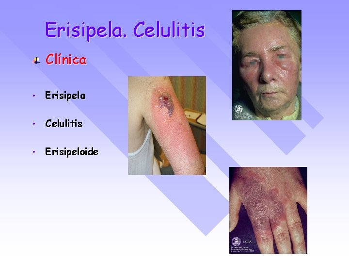 Erisipela. Celulitis Clínica • Erisipela • Celulitis • Erisipeloide 