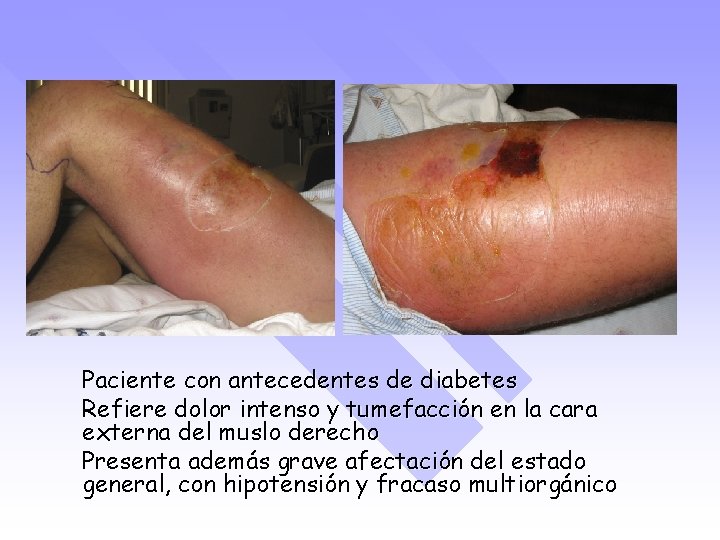 Paciente con antecedentes de diabetes Refiere dolor intenso y tumefacción en la cara externa