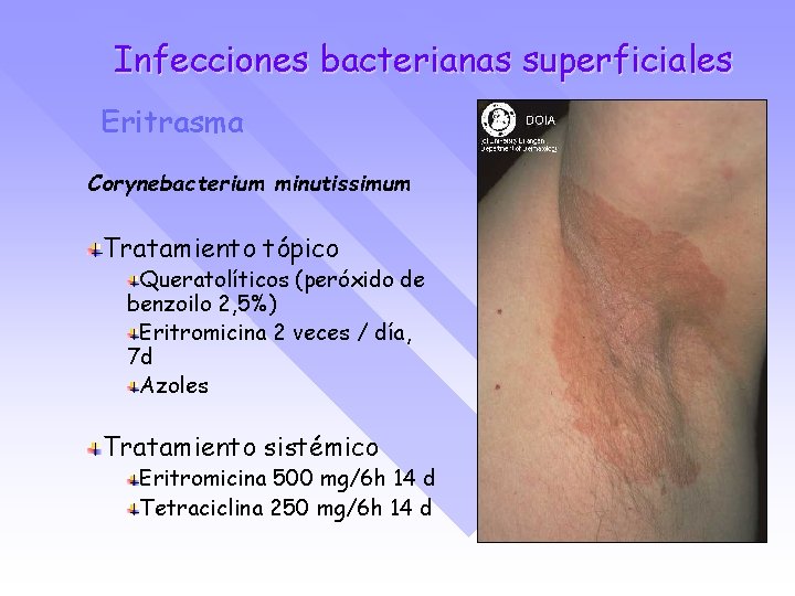 Infecciones bacterianas superficiales Eritrasma Corynebacterium minutissimum Tratamiento tópico Queratolíticos (peróxido de benzoilo 2, 5%)
