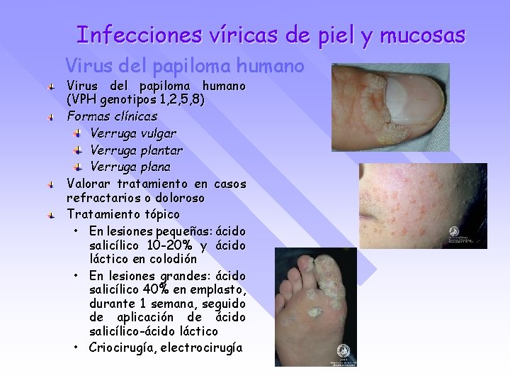 Infecciones víricas de piel y mucosas Virus del papiloma humano (VPH genotipos 1, 2,
