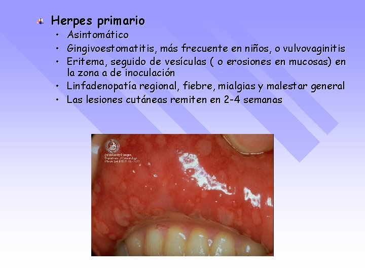 Herpes primario • • • Asintomático Gingivoestomatitis, más frecuente en niños, o vulvovaginitis Eritema,