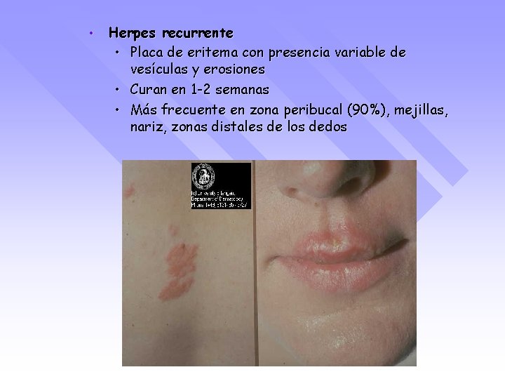  • Herpes recurrente • Placa de eritema con presencia variable de vesículas y