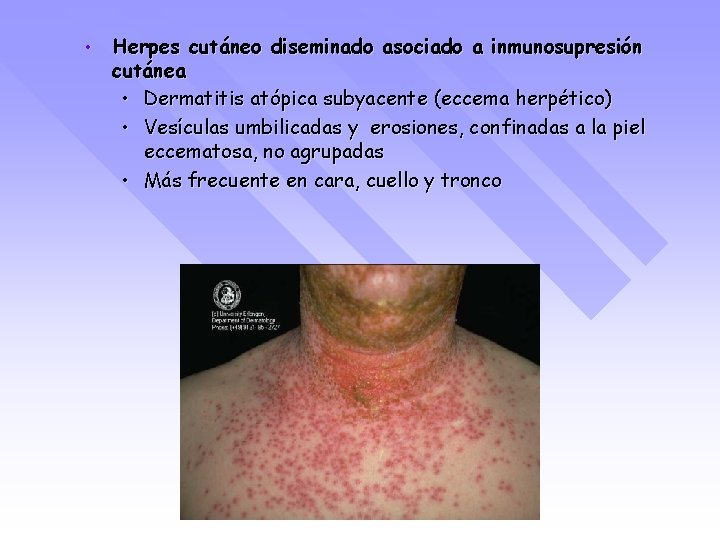  • Herpes cutáneo diseminado asociado a inmunosupresión cutánea • Dermatitis atópica subyacente (eccema
