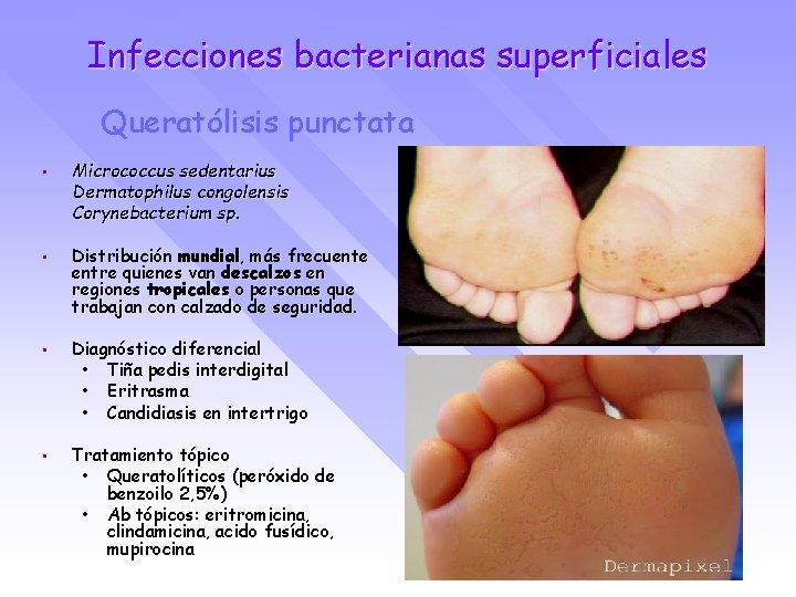 Infecciones bacterianas superficiales Queratólisis punctata • Micrococcus sedentarius Dermatophilus congolensis Corynebacterium sp. • Distribución