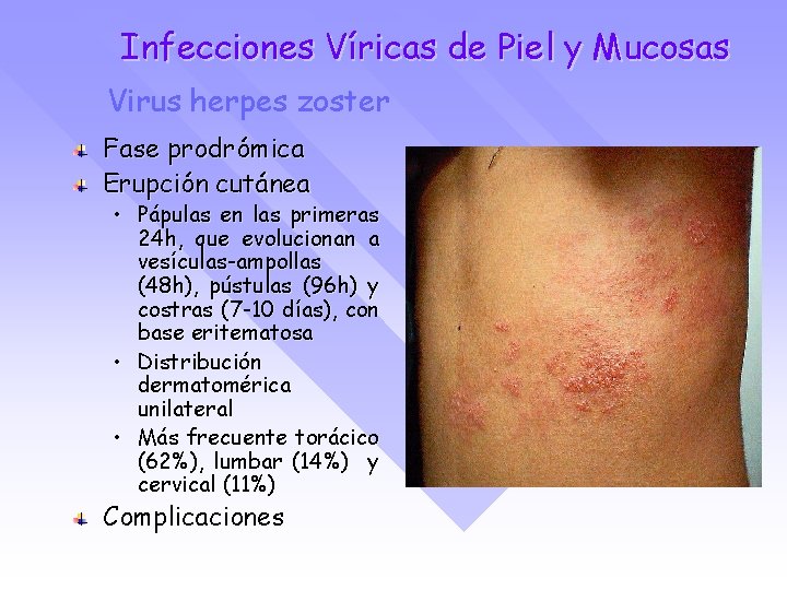 Infecciones Víricas de Piel y Mucosas Virus herpes zoster Fase prodrómica Erupción cutánea •
