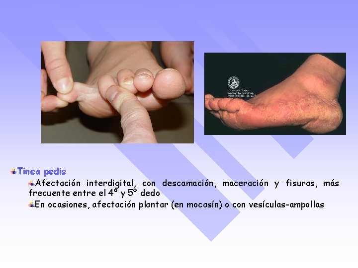 Tinea pedis Afectación interdigital, con descamación, maceración y fisuras, más frecuente entre el 4º