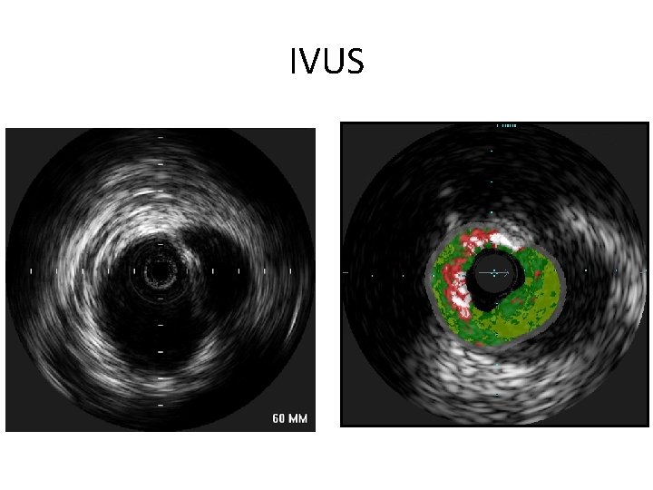 IVUS 