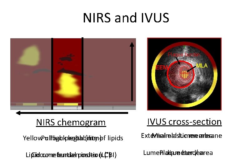 NIRS and IVUS Plaque burden MLA EEM Lumen NIRS chemogram Yellow = high probability