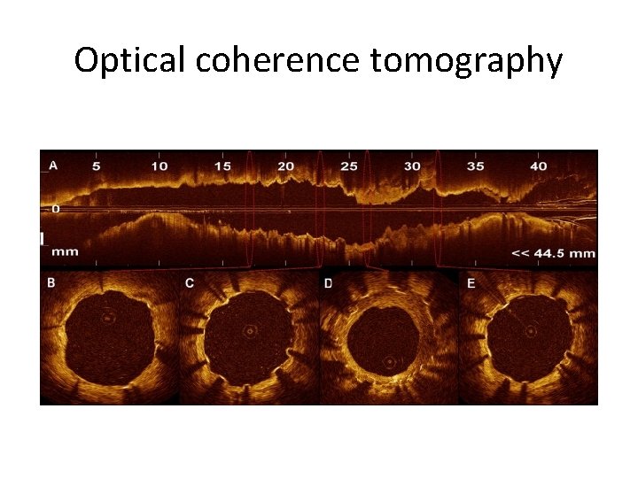 Optical coherence tomography 